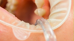 中山伺服超聲波塑料焊接機(jī)：醫(yī)用擴(kuò)張器焊接生產(chǎn)中的創(chuàng)新應(yīng)用